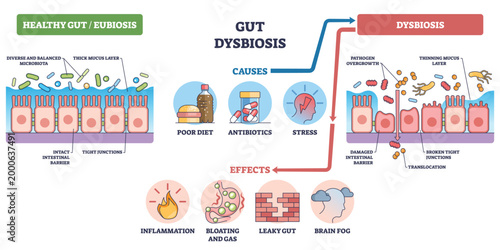 Gut dysbiosis outline shows shift from healthy microbiota to damaged intestinal barrier, highlighting epithelial cells, pathogens, and causes like diet, antibiotics, stress. Outline diagram