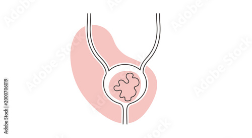 An illustration depicting the urinary bladder with a stone or tumor formation inside, showcasing a medical concept in a clean, modern style