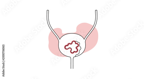 An abstract illustration depicting a tumor growth within a human bladder, suggesting a medical condition or health concern related to internal organs
