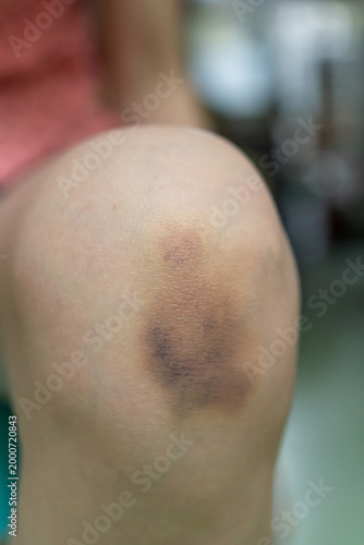 Close-up of a bruised knee with dark discoloration, suggesting a recent minor injury and tenderness.