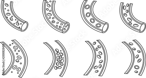 Artery plaque buildup vector set illustrating cholesterol blockage stages in blood vessels medical anatomy and cardiovascular health