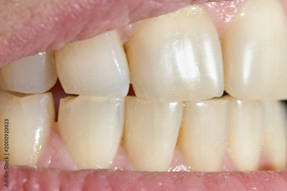 Ταπετσαρία Healthy Looking Human Teeth In Bite Close Up Frontal View Dental Alignment Natural Lighting
