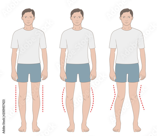 O脚、X脚、正常な脚の比較イラスト