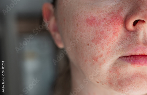 Foto Close-up of a young womans face with visible skin irritation and redness