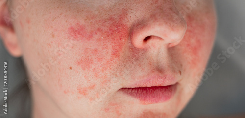 Close-up of a young womans face with visible skin irritation and redness. Inflamed, dry, and textured skin. Concept of sensitive skin, allergy, inflammation, and skincare problems
