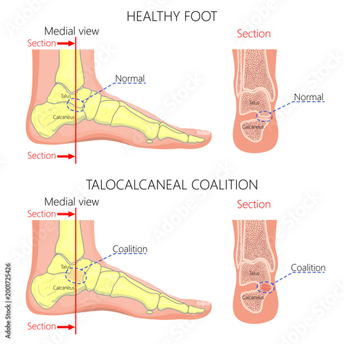 Normal foot and a foot with talocalcaneal coalition