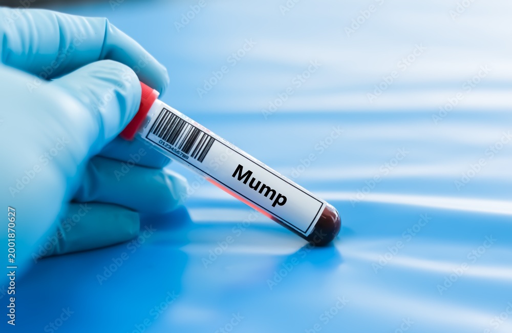 Fototapeta premium Blood sample tube for mump virus test analysis.