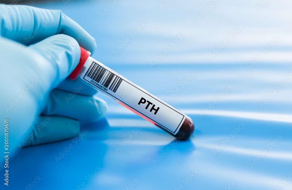 Obraz premium Blood sample tube for parathyroid hormone test analysis.