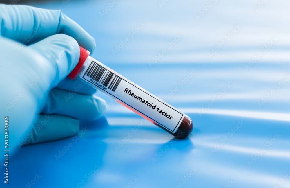Obraz premium Blood sample tube for rheumatoid factor test analysis.