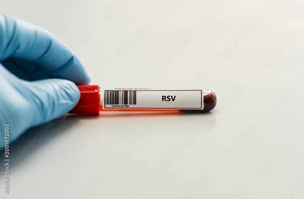 Obraz premium Blood sample tube for respiratory syncytial virus (RSV) test analysis.