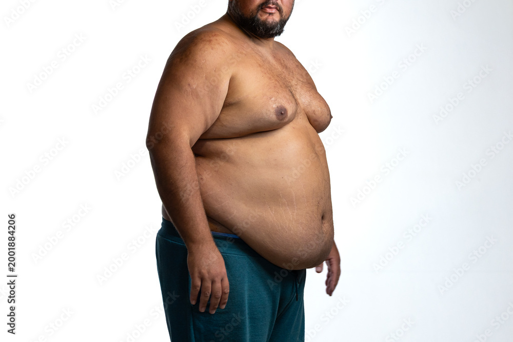 Naklejka premium Overweight man with abdominal obesity