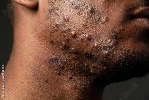 Severe inflammatory acne and folliculitis on Black man face