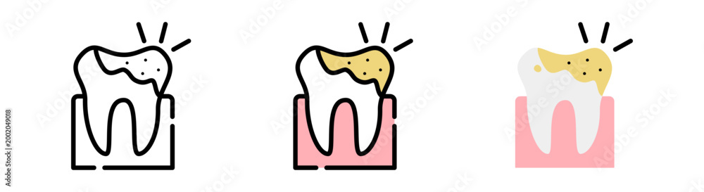 Obraz premium Dental caries (tooth decay) and plaque buildup.