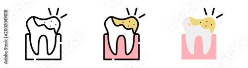 Dental caries (tooth decay) and plaque buildup. 