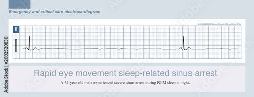 Fotografía During sleep, especially rapid eye movement (NREM) sleep, vagal tone increases, making various bradycardias, such as sinus pauses, more likely to occur