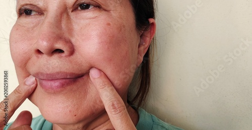 portrait of a woman holding the flabbiness and Flabby skin, smile lines beside the mouth, freckles and blemish, scar and loose, emotion and expression on the face, health care and beauty concept.