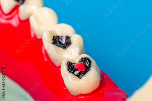 Εκτύπωση καμβά Dental care model illustrating tooth decay and cavities