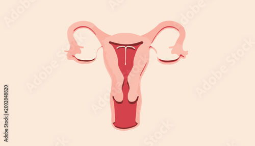 Illustration of the female reproductive system with an intrauterine device (IUD) inserted for contraception