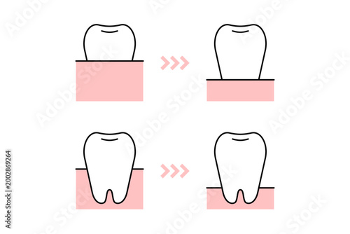 歯茎が下がる状況をイメージしたイラスト―歯周病や知覚過敏の表現に使える素材