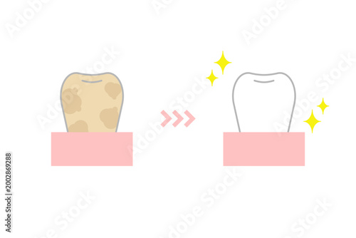 汚い歯がホワイトニングで清潔できれいな歯になるイメージイラスト