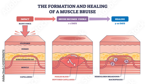 Muscle bruise formation and healing shown stepwise, from impact to repair via pooled blood, ruptured capillaries, and macrophages. Outline diagram