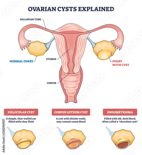 Ovarian cysts explained, simplified reproductive anatomy comparing uterus, normal ovary, and ovary with cyst to show types and causes for patients and students. Outline diagram