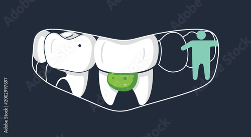 Dental health illustration showing teeth with green plaque and a small character representating hygiene issues and tooth decay.
