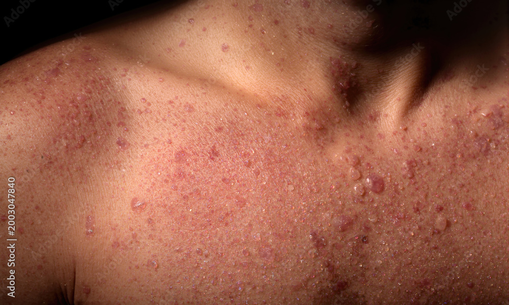 Fototapeta premium Close-up View of Inflamed Human Skin With Visible Folliculitis Representing Challenging Dermatological Conditions and Pathology