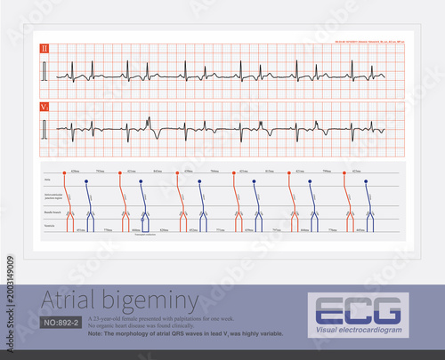 Photos A sinus beat and an atrial premature beat alternate