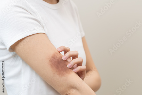 Принти на полотні Close up of stain bruise wound on arm, contusion asian young woman, girl an acci