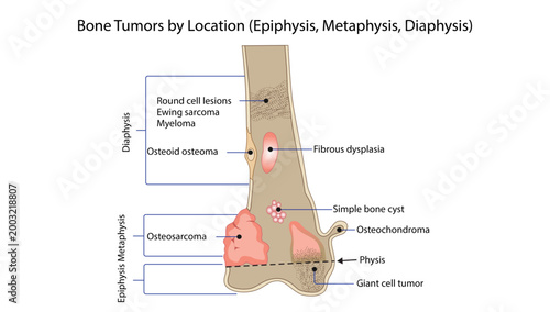 Bone Tumors by Location (Epiphysis, Metaphysis, Diaphysis)
bone tumors according to their typical location within long bones.