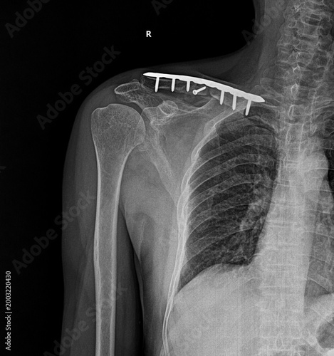 Slika na platnu Clinical X-ray of the thoracic cavity and shoulder girdle with visible surgical hardware on the collarbone