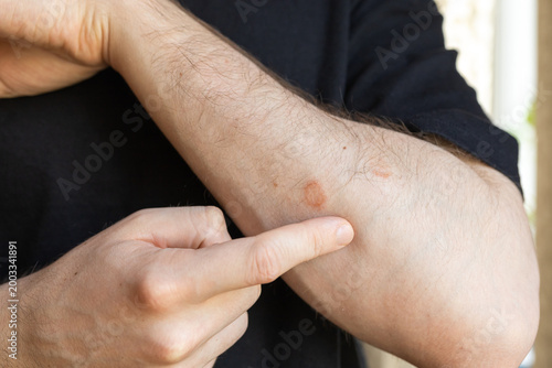 Tableau sur toile Ringworm fungal skin infection on male arm close up, dermatology problem