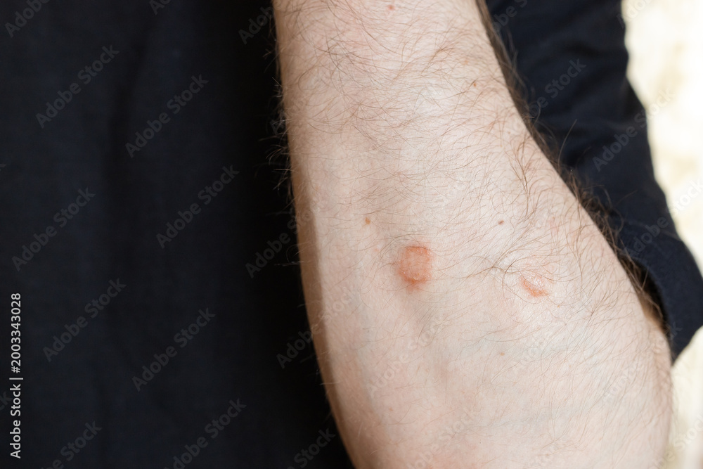 Naklejka premium Circular skin rash on male arm close up, dermatological condition or fungal infection 