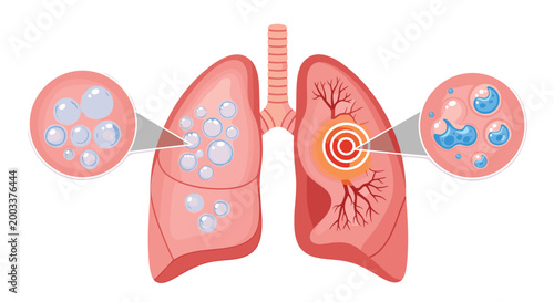 Medical illustration of human lungs with localized inflammation and magnified views of infected air sacs with fluid.