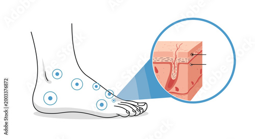 Medical diagram showing foot skin condition with magnified cross section view of inflamed dermal layers and tissue.