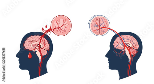 Medical diagram showing different types of stroke in the brain including hemorrhagic and ischemic with blood vessels.