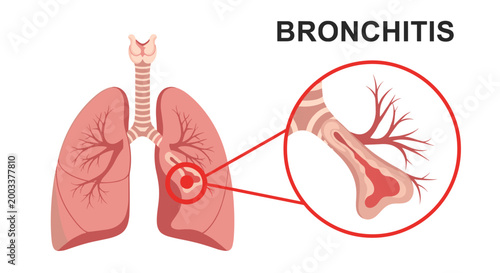 Anatomical illustration of human lungs with a magnified view of an inflamed bronchus labeled for bronchitis.