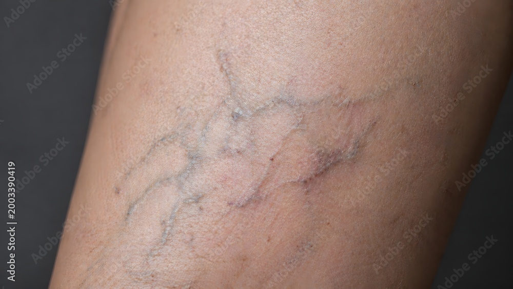 Fototapeta premium Detailed texture of varicose veins on human leg, dermatology and vascular health concept