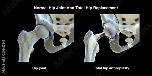 Photos Normal healthy hip joint with intact femoral head, acetabulum, articular cartilage and joint space, and total hip replacement, 3D illustration