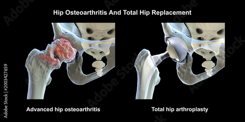 Advanced hip osteoarthritis with joint space narrowing, osteophytes and cartilage loss, and total hip replacement prosthesis, 3D illustration.