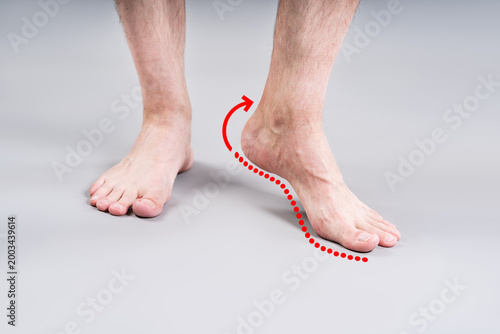 Flat feet correction exercise. Male foot with red arrow showing arch lifting movement, podiatry therapy concept