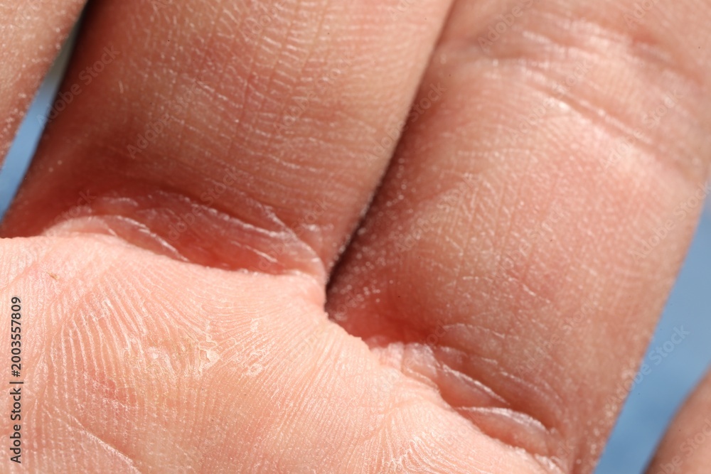 Fototapeta premium Man with dry skin on his hand, closeup