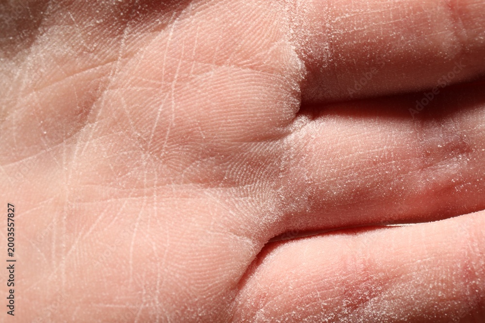 Fototapeta premium Man with dry skin on his hand, closeup