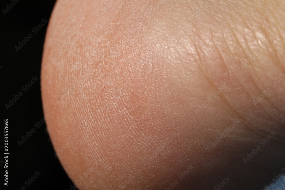 Fototapeta premium Man with dry skin on his foot against black background, closeup