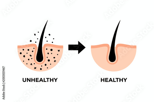 Hair Follicle Comparison of Unhealthy and Healthy Scalp Illustration