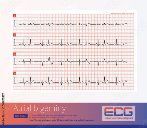 Tableau sur toile A sinus beat and an atrial premature beat alternate