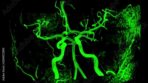 Cerebral angiography brain vessels green fluorescent imaging. Medical 3D reconstruction showing intracranial arteries and vascular network used for neurosurgical planning and diagnostic radiology.