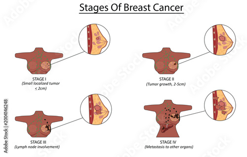 Stages of breast cancer vector illustration