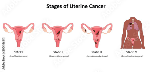 Stages of uterine cancer vector illustration